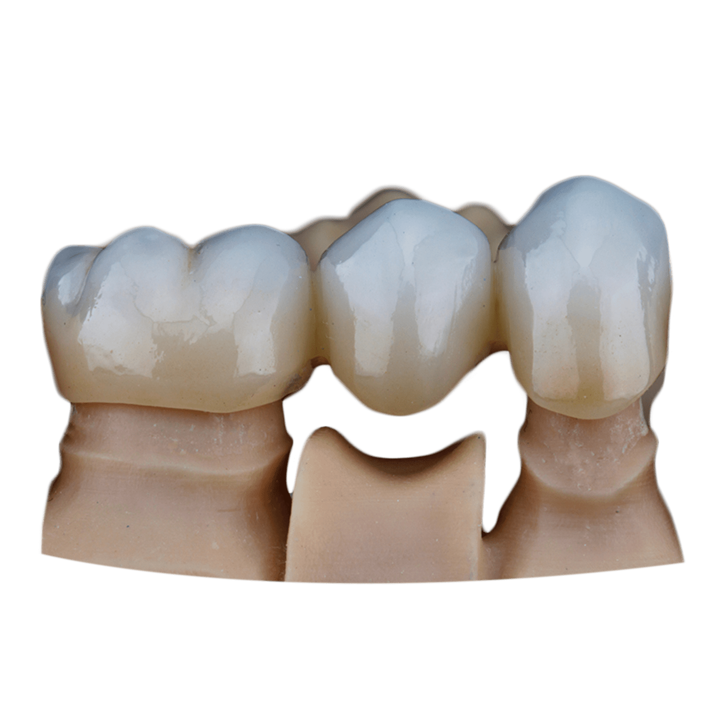 Zirconium Crowns Istanbul Turkey Cost Benefit Before After