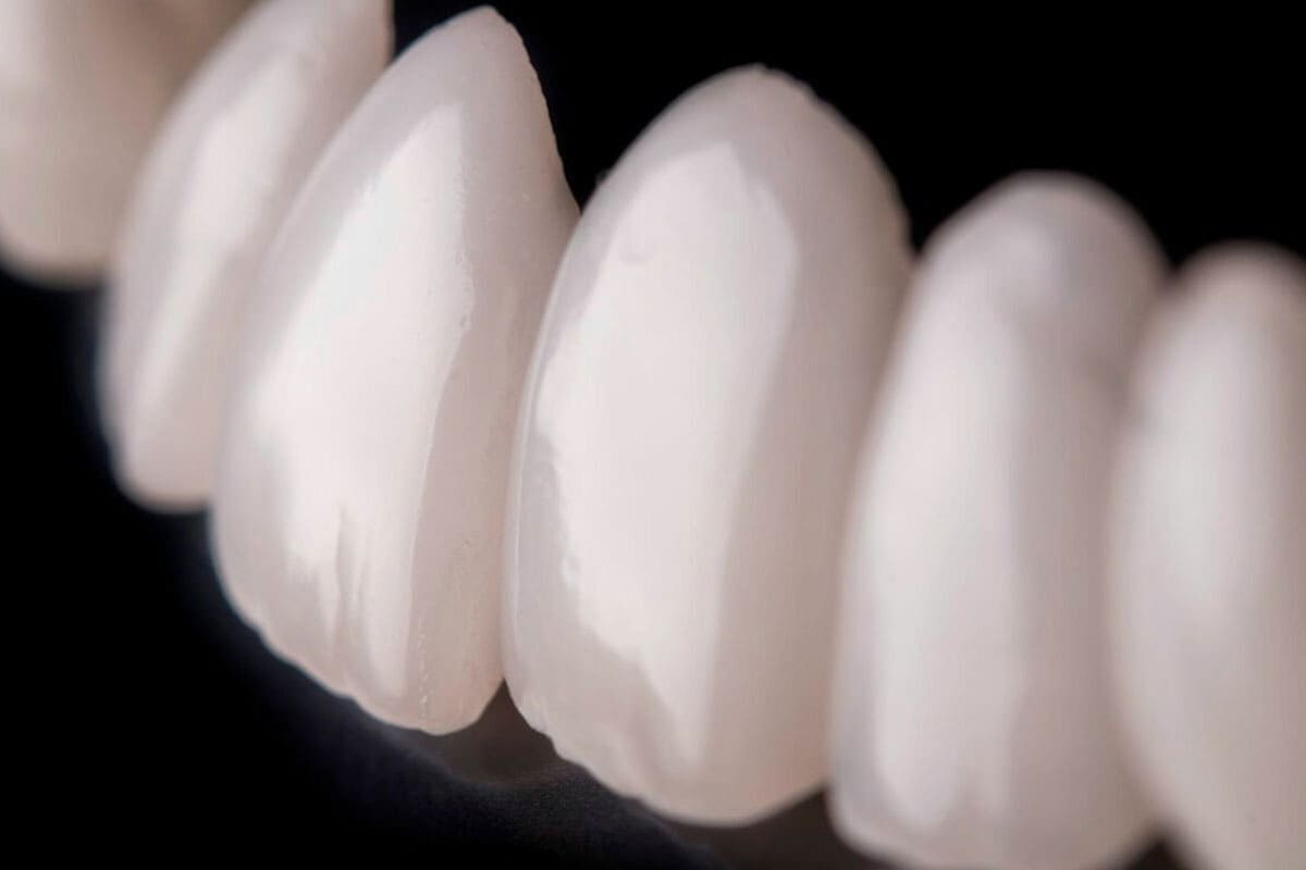 Emax Veneers in Turkey: Benefits and Dental Care