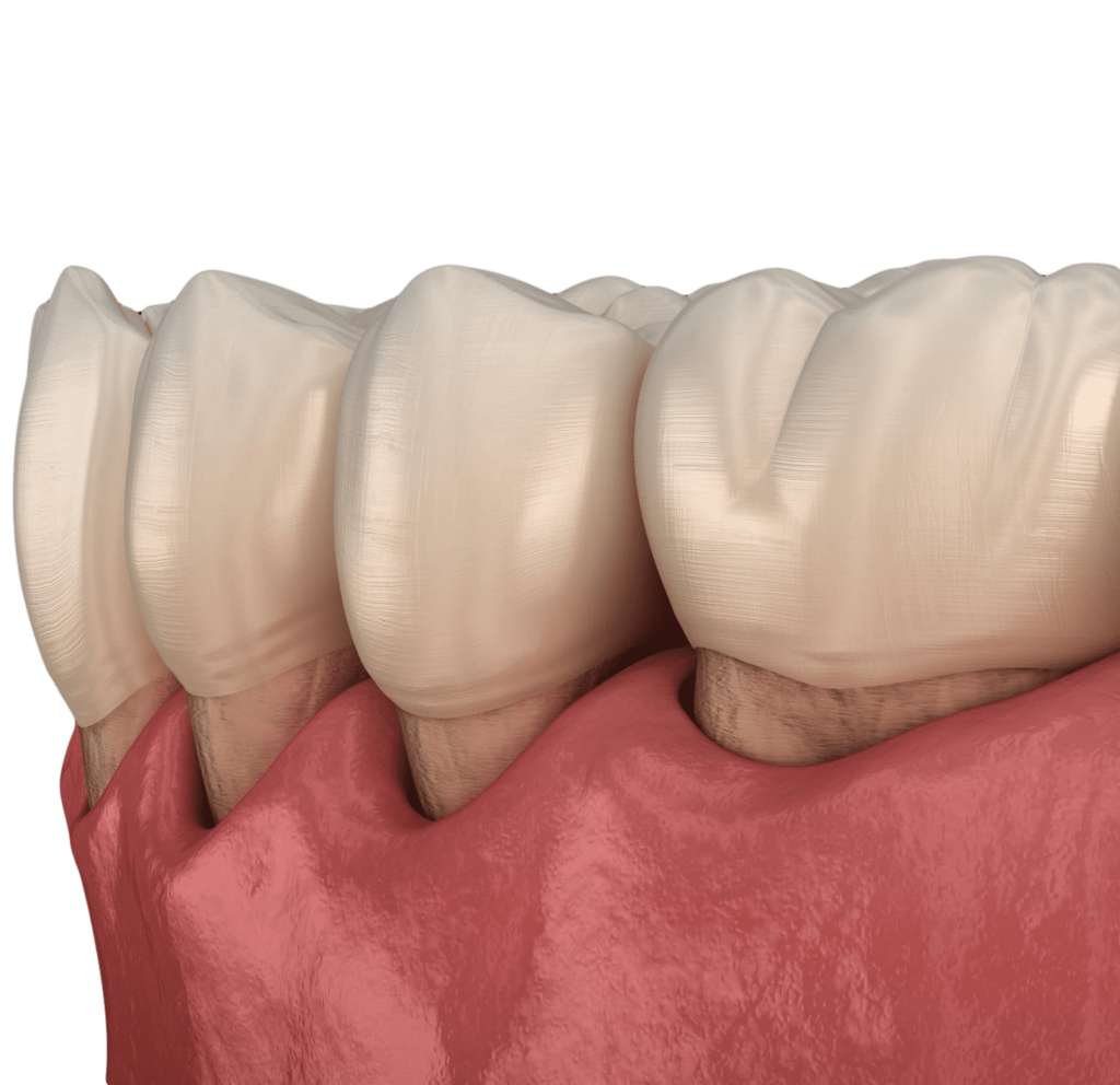 Gum-Treatments-Gum-Graft-Istanbul-Turkey