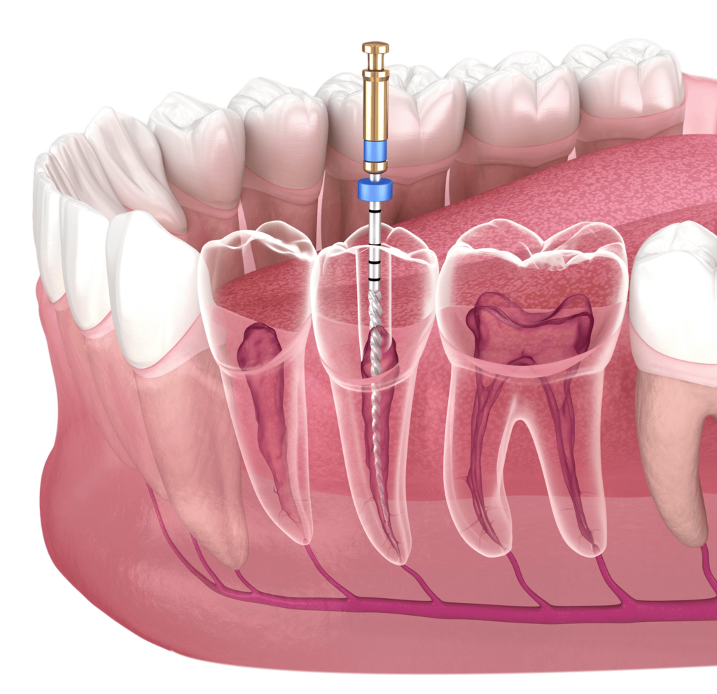 Root Canal Treatment Price | Endodontics in Turkey, Istanbul