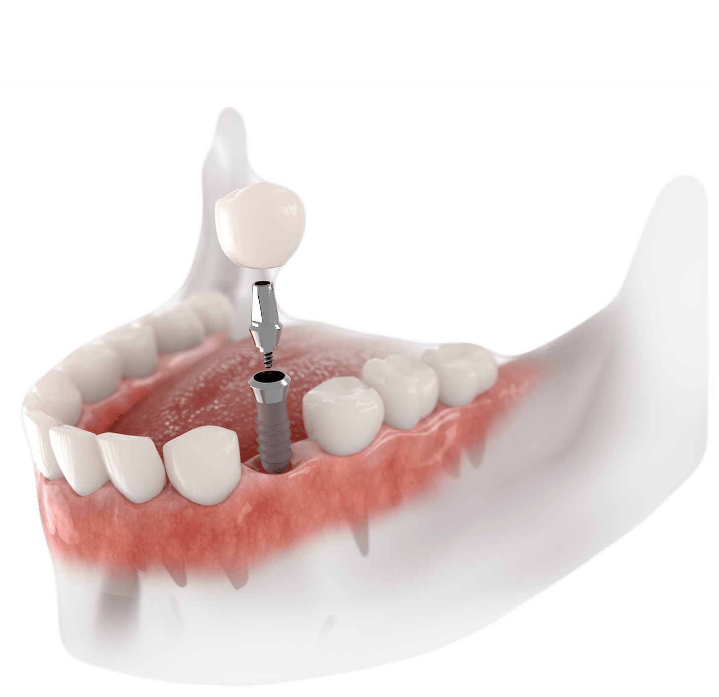 Dental Implants Turkey Istanbul Tooth Implant Turkey Dental Clinic