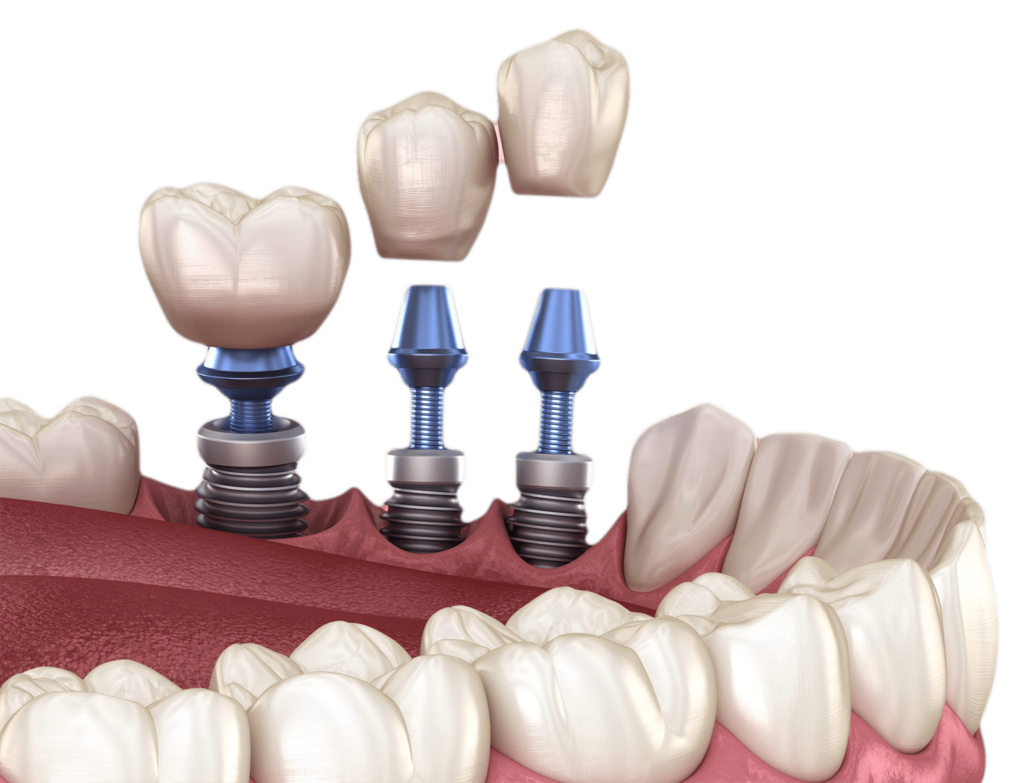 all on 4 dental implants turkey price dental clinic istanbul dentist istanbul turkey