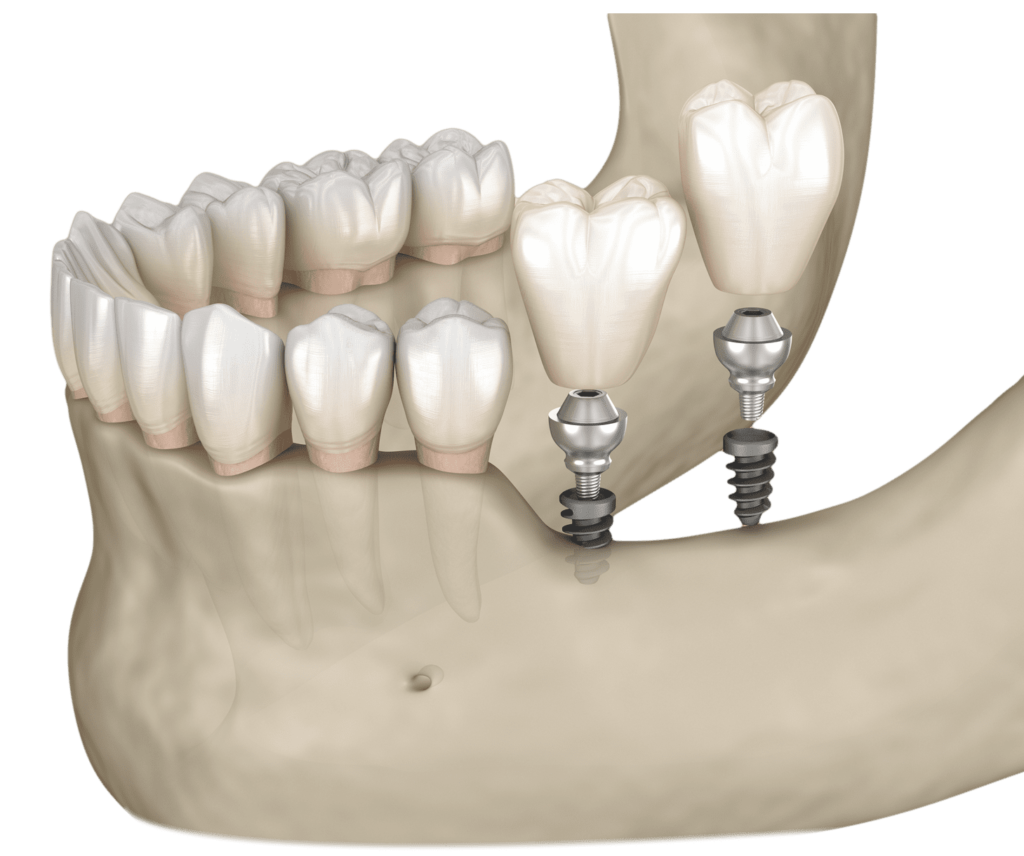 dental implant treatments clinic dentist istanbul turkey