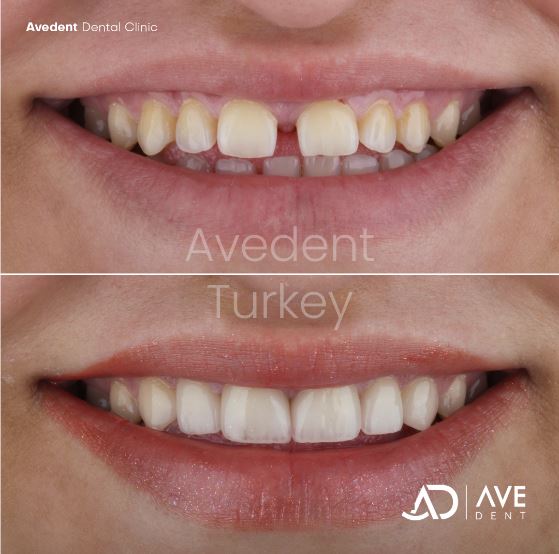 6 pieces of ultra natural e-max laminate veneers.