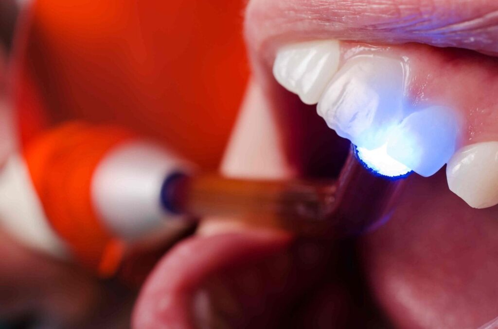 Teeth Whitening Temporary Filling Teeth Repair Broken Tooth Gaps Kit -  China Dental Filling Material, Resin-Based