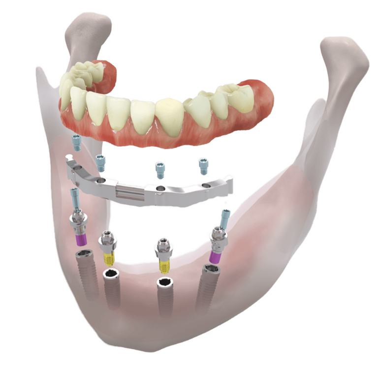 All On Four - All On Six - Dental Implant Turkey