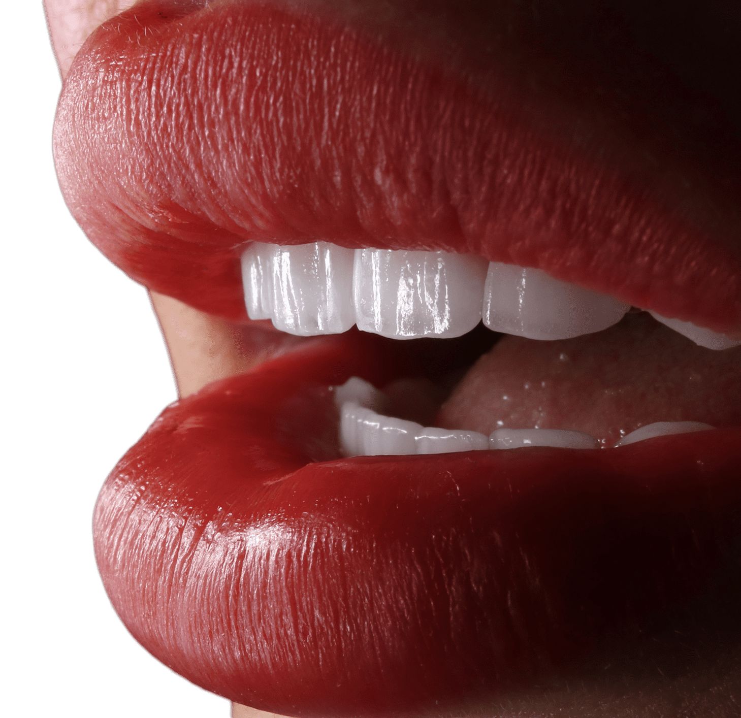 Dental Veneers in Turkey Veneer Teeth Istanbul