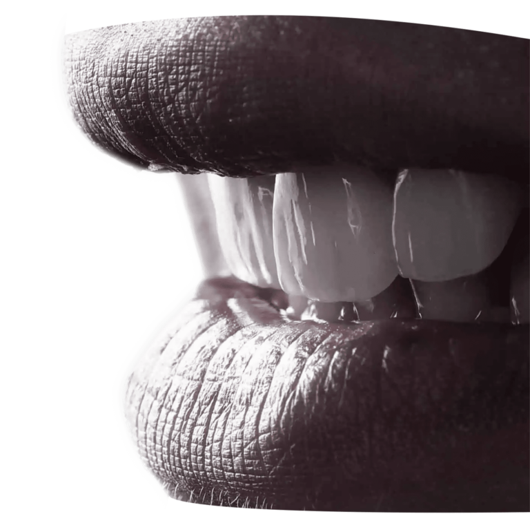 Emax veneers Turkey costs - Emax porcelain crown Istanbul review