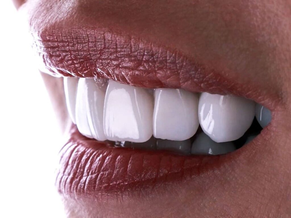 Emax veneers Turkey costs Emax porcelain crown Istanbul review