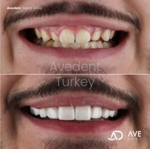 We applied 10 pieces of zirconium crowns and whitening!