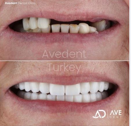 We applied 12 implants ( all-on-six) and 24 pieces of zirconia crowns. She chose colour, shape and size of her new teeth with our team!
