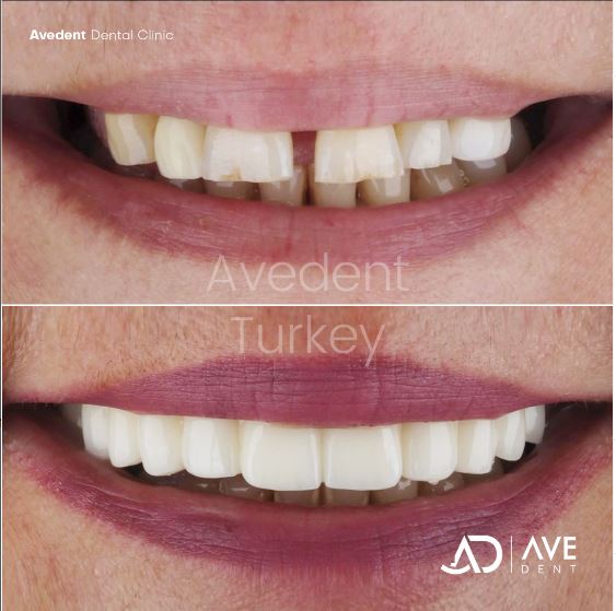 Amazing smile design with All-on-six concept.