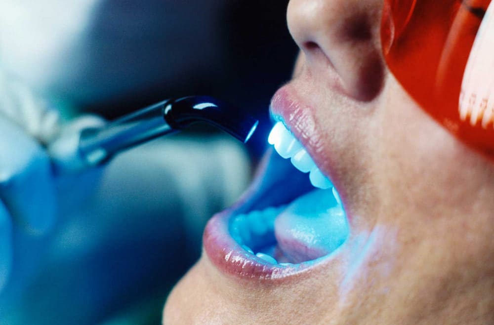 Teeth Whitening Bleaching Istanbul Turkey