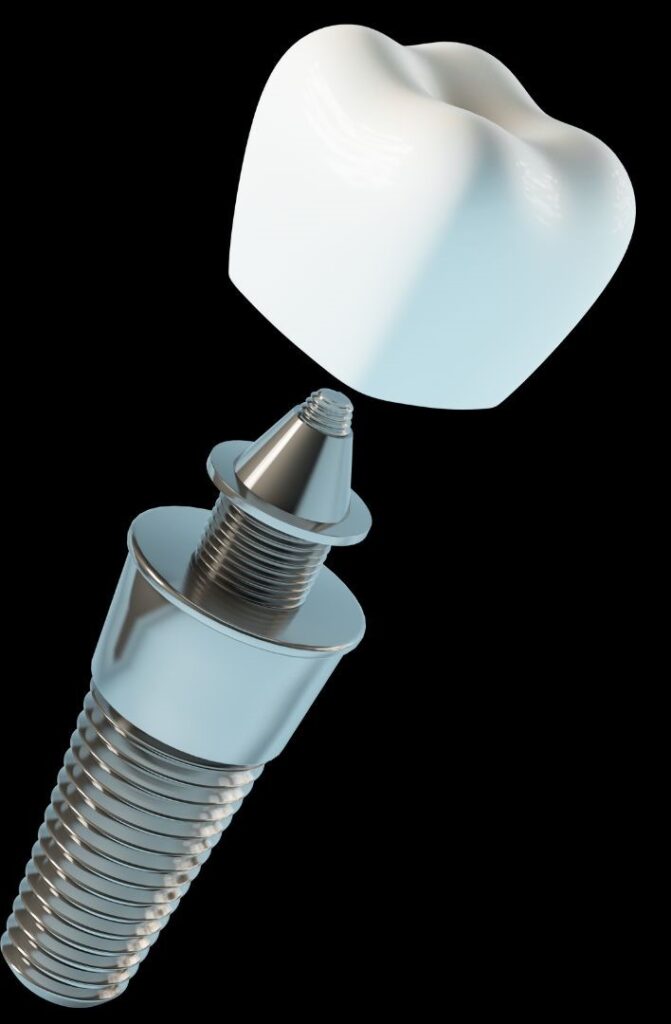 what is a dental implant in turkey, istanbul?