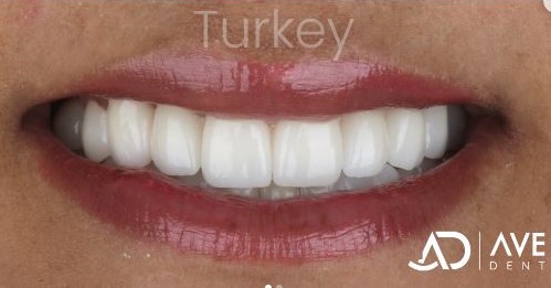 zirconia crowns vs porcelain