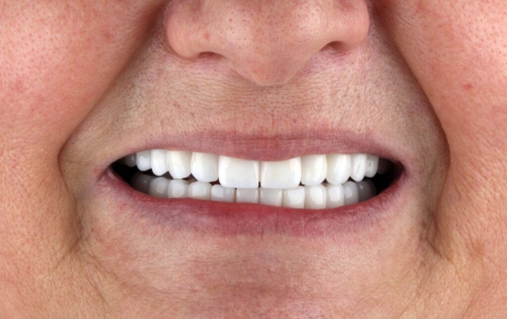 teeth whitening dental clinic istanbul turkey