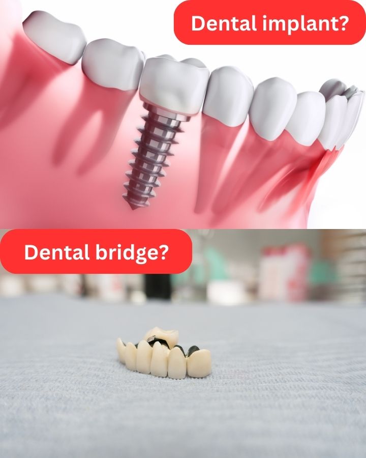 dental implant or dental bridge?