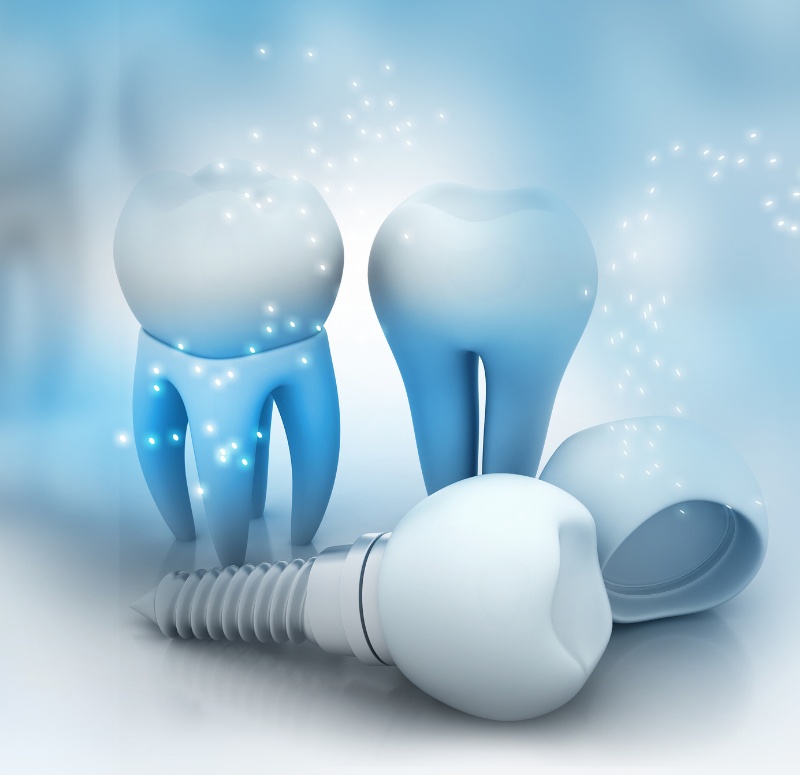 What is screwless dental implants? Screw implant or bonding?