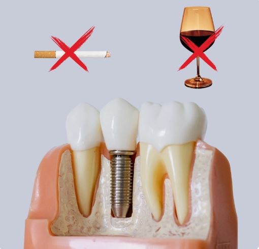 can-you-smoke-drink-alcohol-after-a-dental-implant-in-turkey