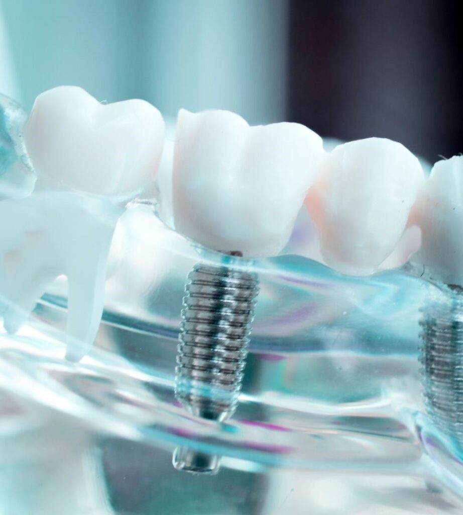 What is flapless / seamless dental implants in Turkey, Istanbul?