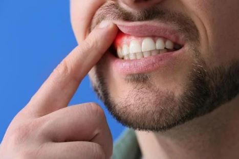 gum disease treatment in turkey