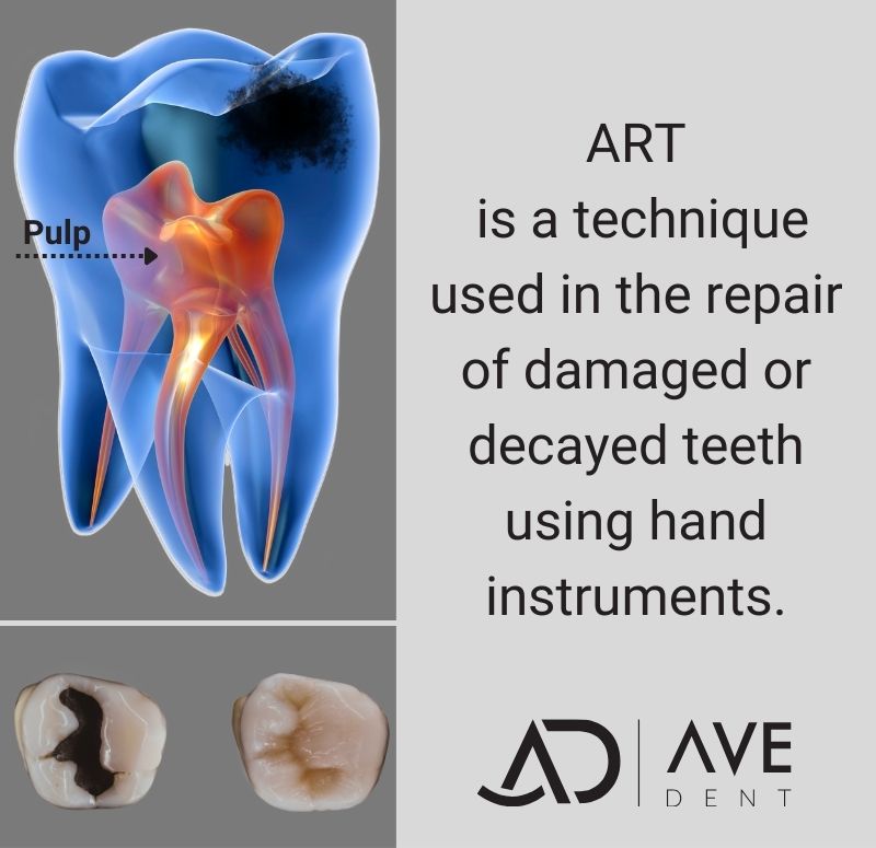 Atraumatic Restorative Treatment (ART) Filling on Decayed teeth