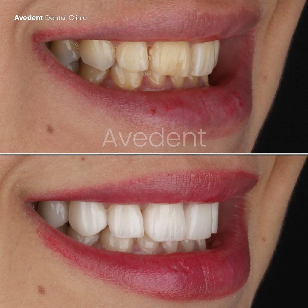 Turkey Teeth in Istanbul: Testimonials & Before and After Photos