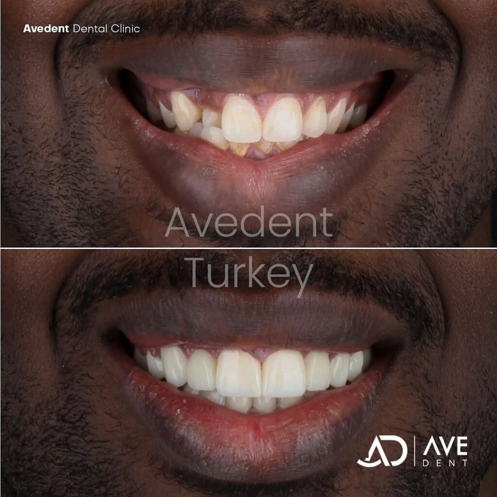 turkey-teeth-in-istanbul-1