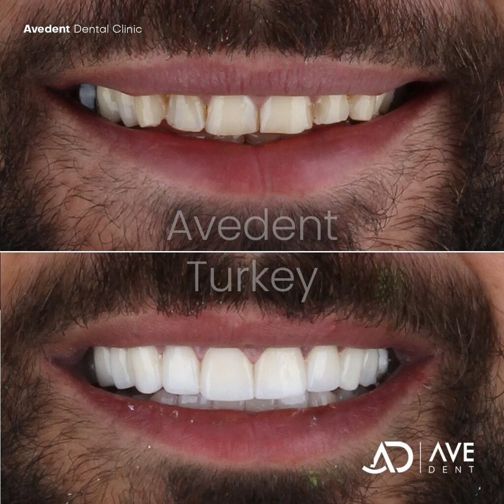 turkey-teeth-in-istanbul-3