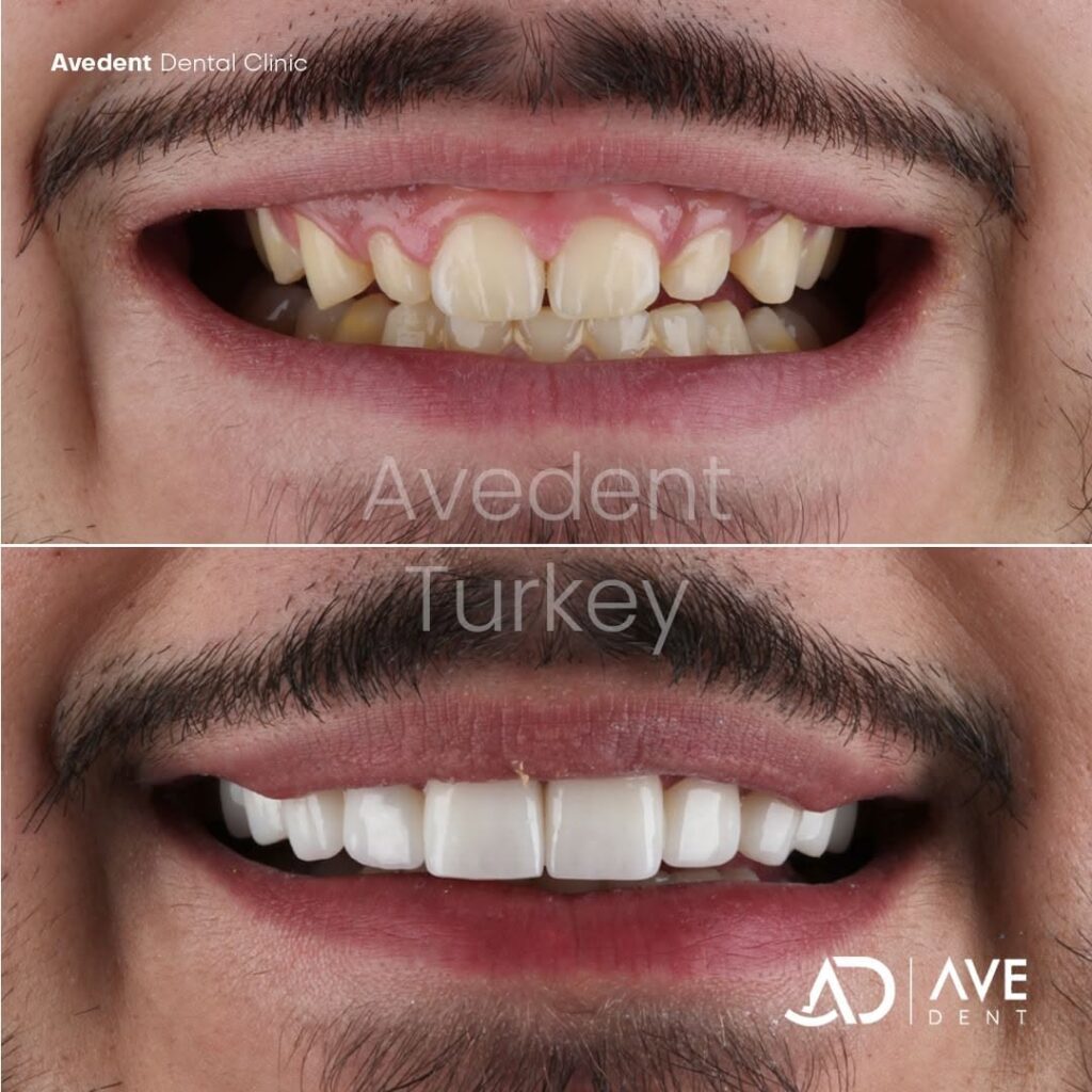 turkey-teeth-in-istanbul-6