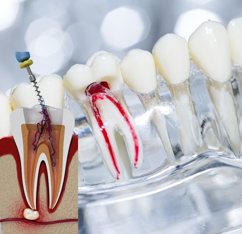 Failed root canal, Root canal failure | Avedent dental clinic Turkey