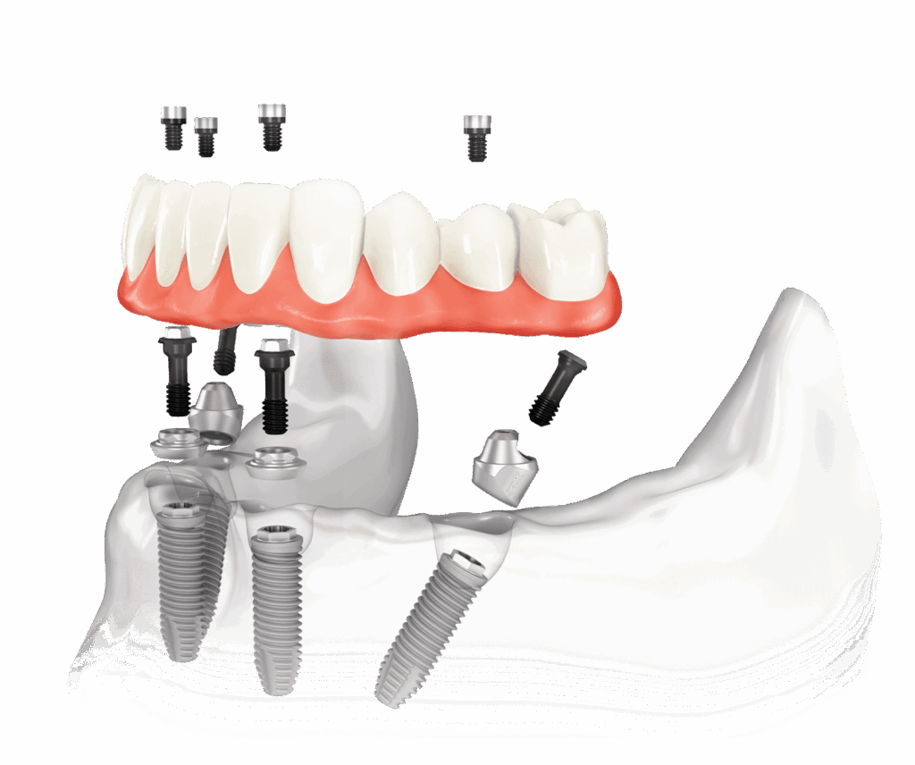 Same Day Implants (Fixed Teeth in a Day)