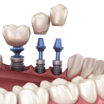 all on 4 dental implants turkey price dental clinic istanbul dentist istanbul turkey
