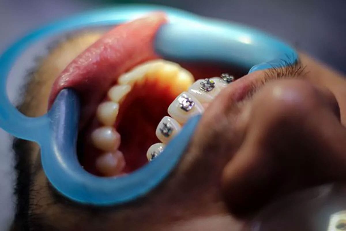 Diş Teli Tedavisi, Braketler ile Tedavi Sonrası Dişlerin Yeni Konumu Nasıl Korunur?