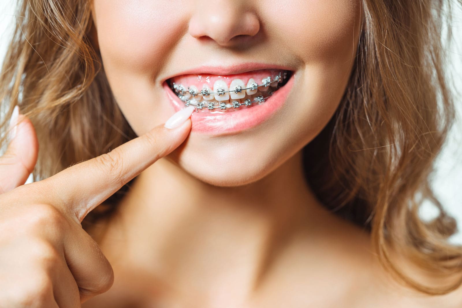 Diş Teli Tedavisi, Braketler ile Tedavi İçin Uygun Yaş Aralığı Nedir?