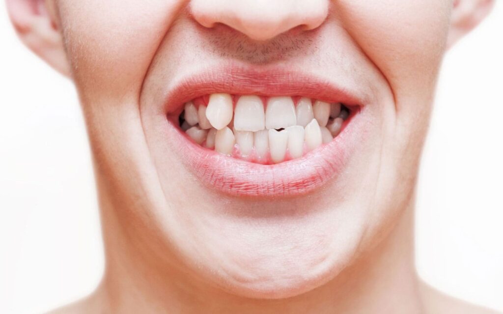 Dişlerdeki Çapraşıklıklar Gülüş Tasarımı ile Tedavi Edilebilir mi?