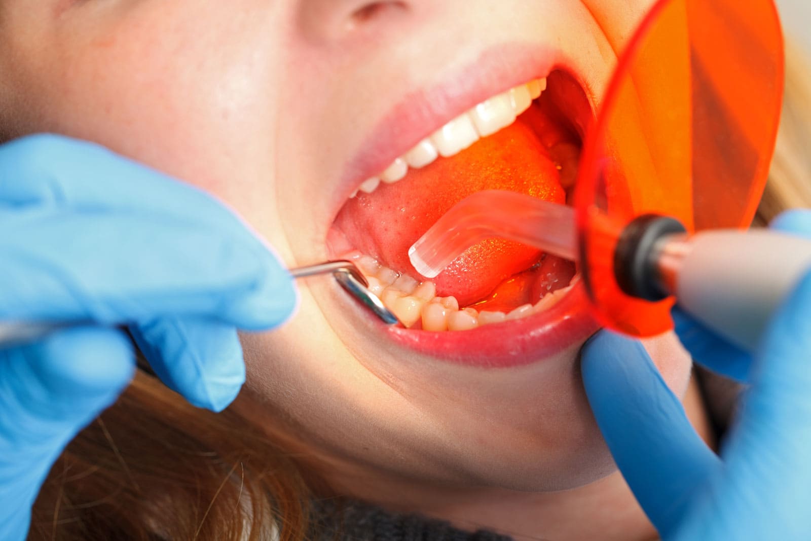 Estetik Diş Dolgusu Tedavi Süreci Nasıldır?