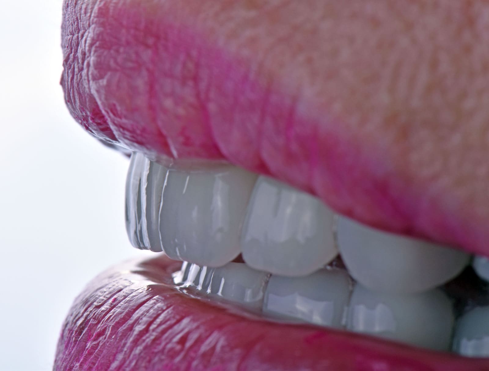 Porselen Lamine Diş Kaplama Tedavisi Sonrası Nelere Dikkat Edilmelidir?