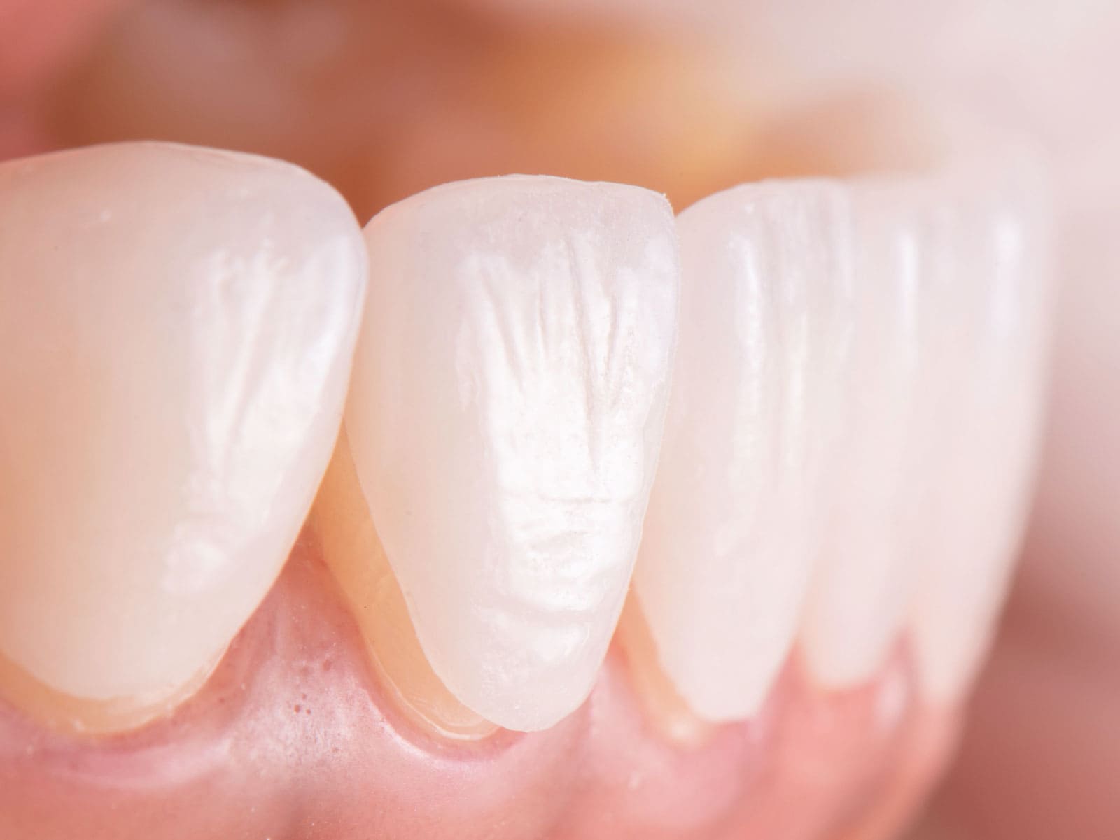 Porselen Lamine Diş Protezlerinin Hangi Durumlarda Tercih Edilmesi Uygun Değildir?