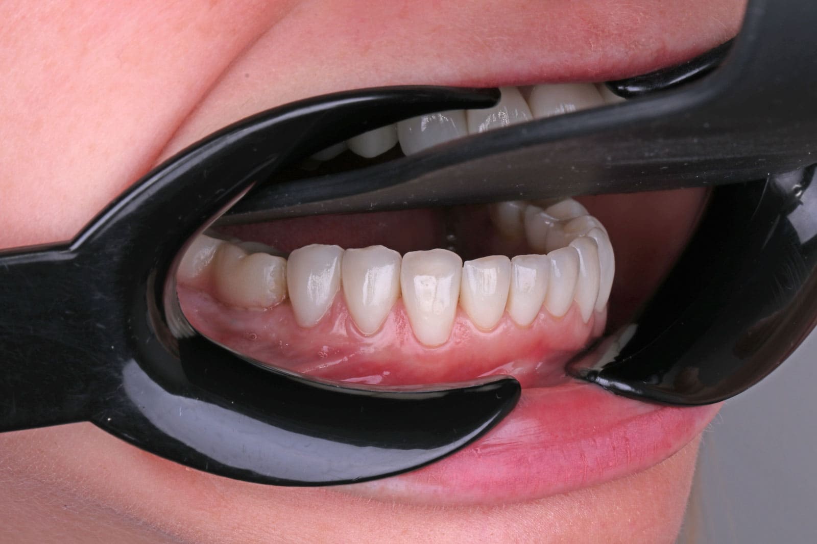 Zirkonyum Diş Kaplamaların Avantajları Nelerdir?