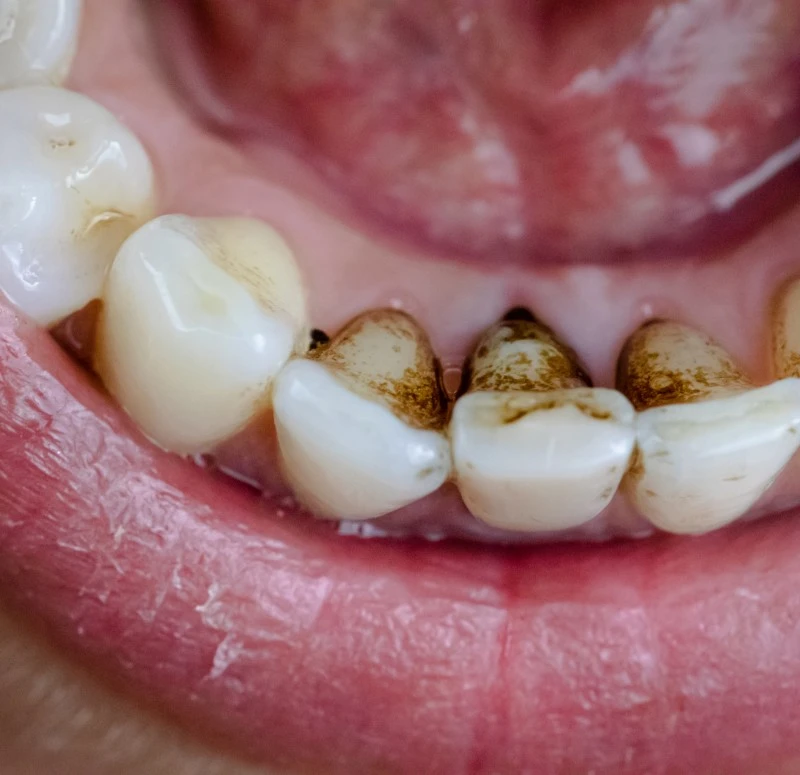 Dişteki siyah lekeler neden olur nasıl geçer?