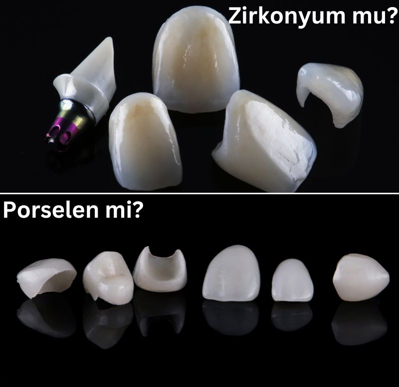 Porselen mi Zirkonyum mu? Porselen Diş mi Zirkon Diş mi Daha İyidir? İstanbul