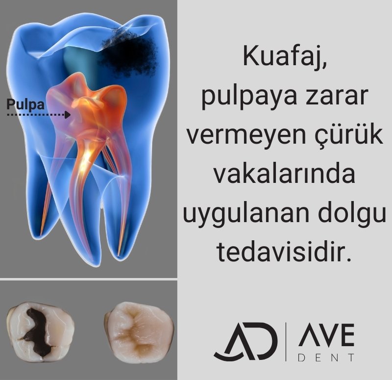 Kuafaj Nedir? Kuafaj Sonrası Ağrı Olur mu? İstanbul Kadıköy