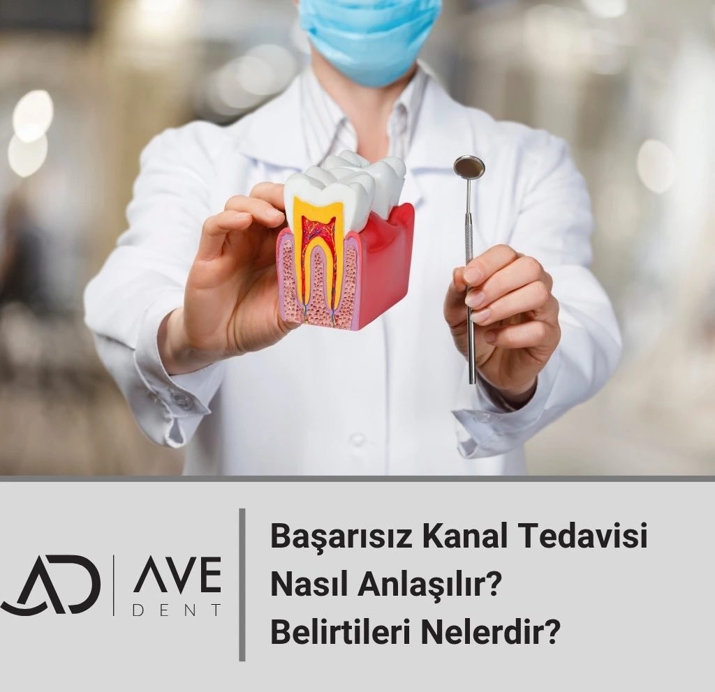Başarısız Kanal Tedavisi Nasıl Anlaşılır? Belirtileri Nelerdir?