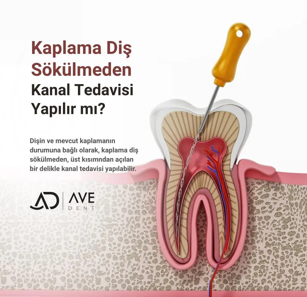 Kaplama Diş Sökülmeden Kanal Tedavisi Yapılır mı?