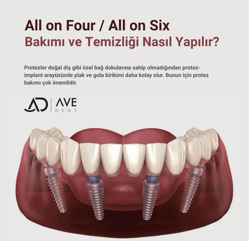 All on Four / All on Six Bakımı Nasıl yapılır? Nasıl Temizlenir?