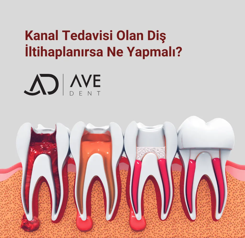Kanal Tedavisi Olan Diş İltihaplanırsa Ne Yapmalı?